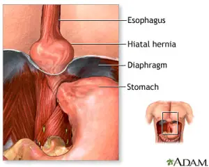 Hiatal Hernia