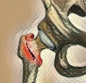 Bone Composition Osteoporosis