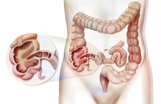 Are Your Health Problems Really Genetic? Discover the Hidden Factors Shaping Your Well-Being Ileocecal valve 2